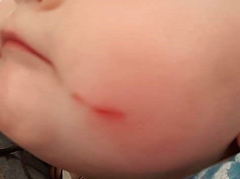 How to Heal a Scar on an Infant without Scarring Naturally at Home?