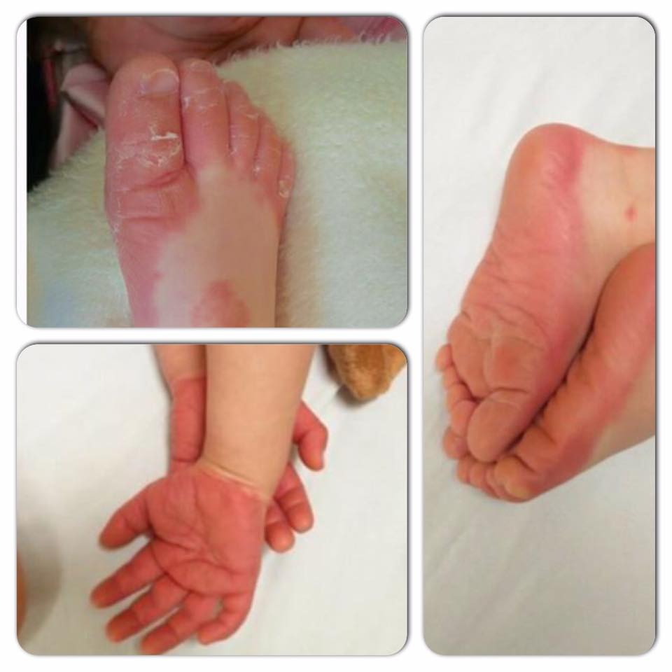 Erythrodermic Psoriasis on an Infant