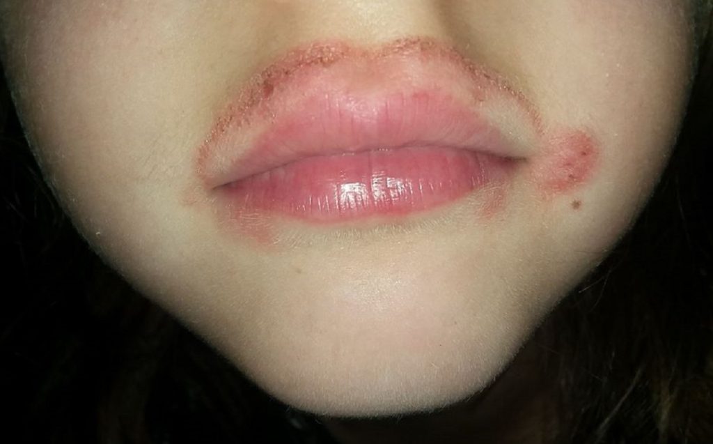 What Causes Rash Around Lips To Kids How To Cure It Naturally 